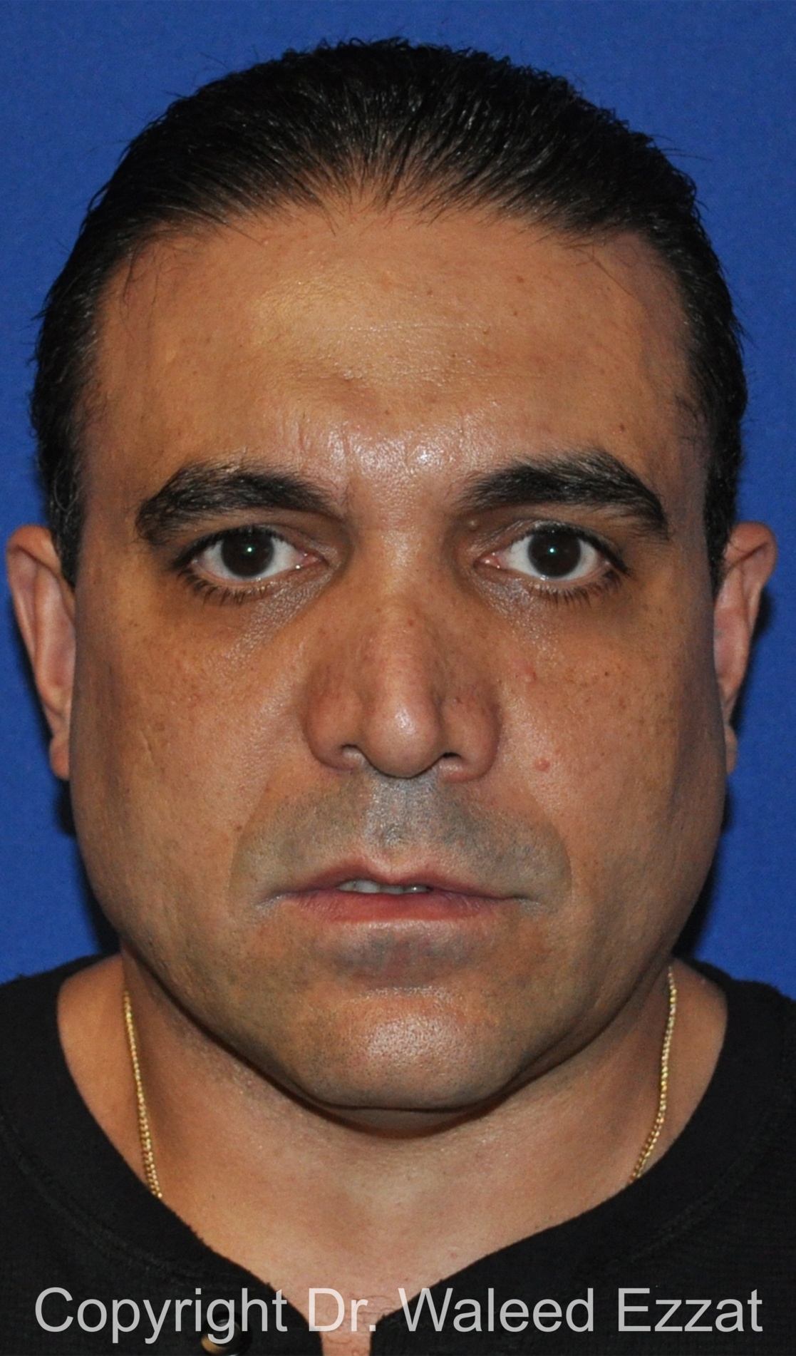 Revision Rhinoplasty Patient Photo - Case 503 - before view-2