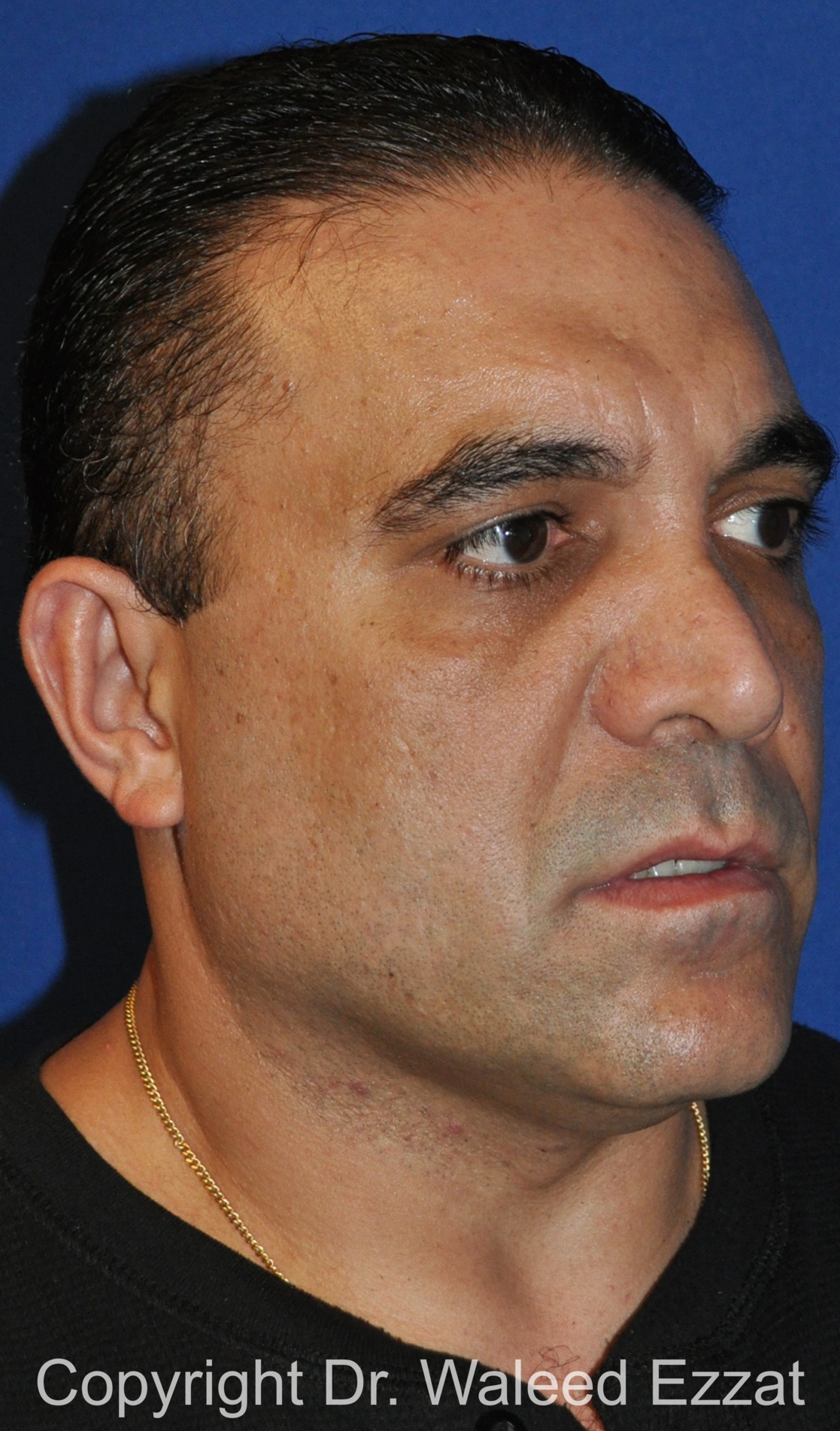 Revision Rhinoplasty Patient Photo - Case 503 - before view-1