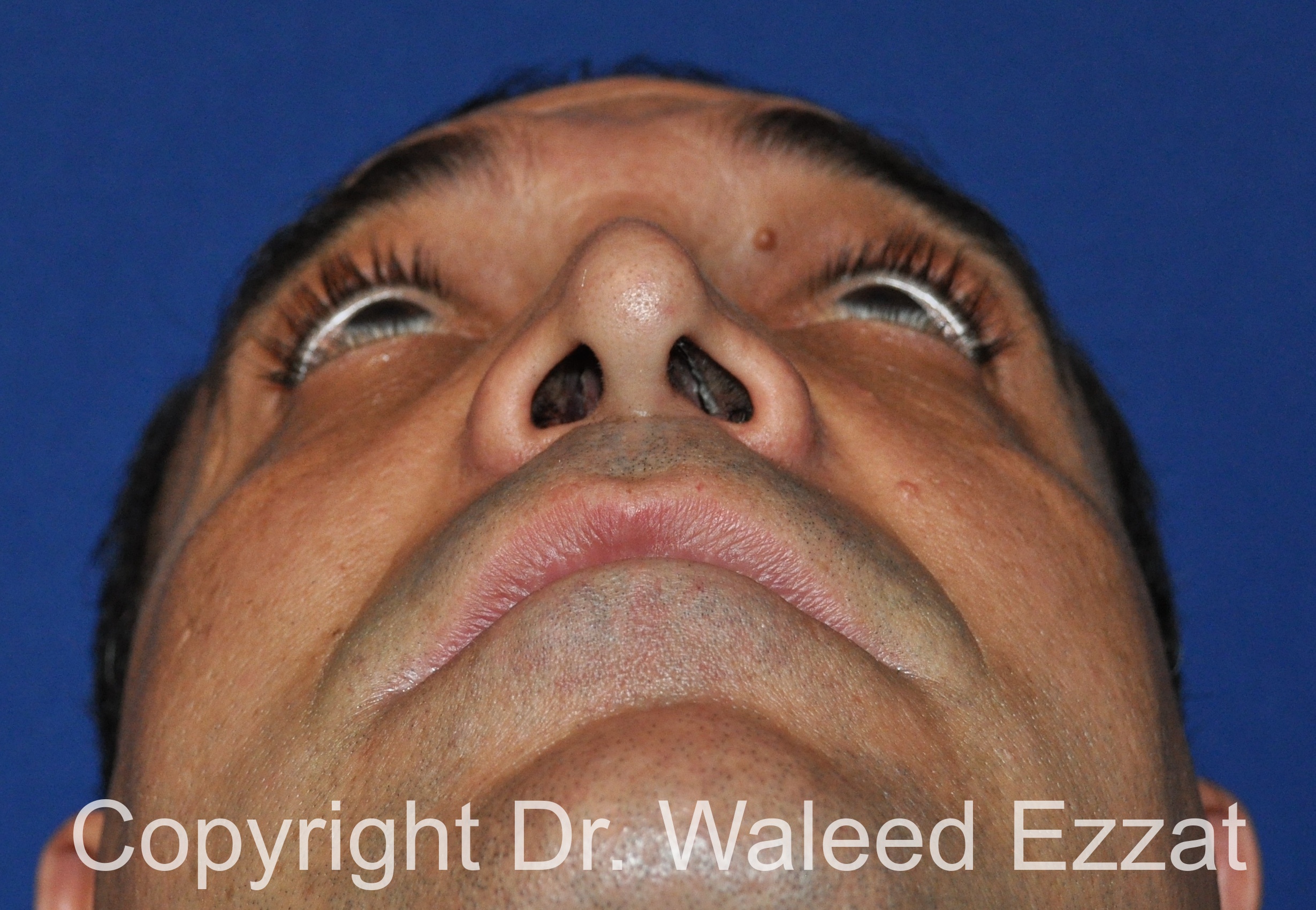 Revision Rhinoplasty Patient Photo - Case 503 - before view-3