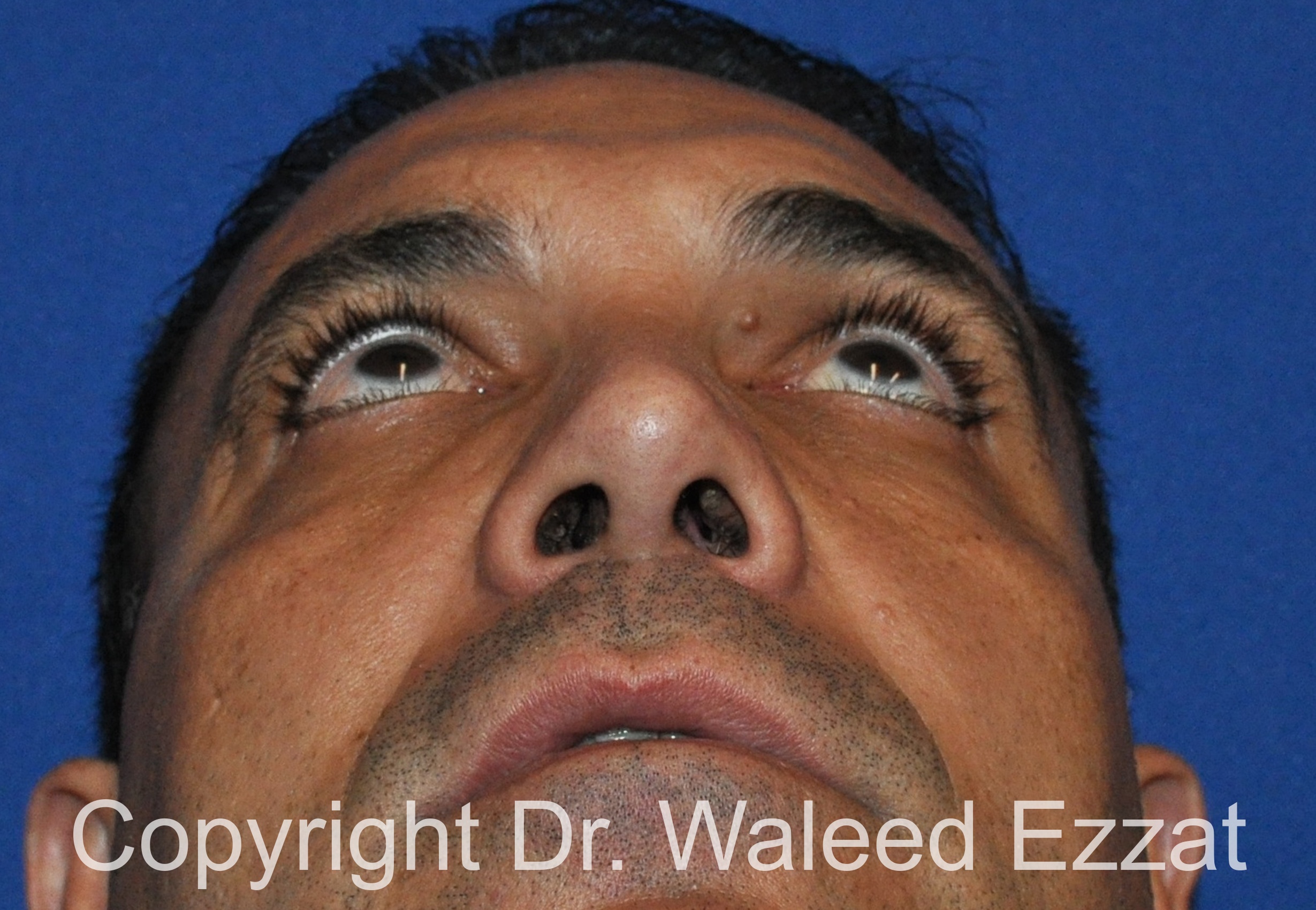 Revision Rhinoplasty Patient Photo - Case 503 - after view-3