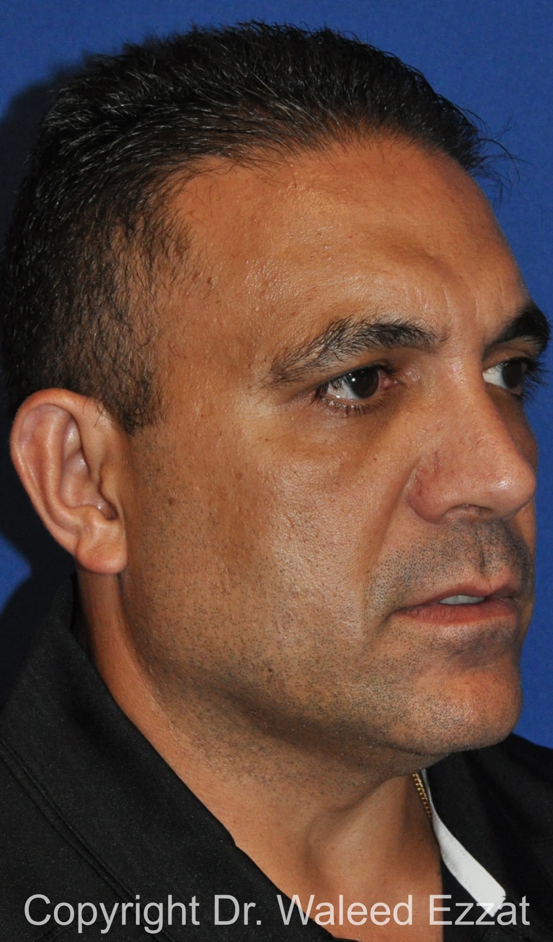 Revision Rhinoplasty Patient Photo - Case 503 - after view-1