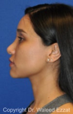 Hispanic/South American Rhinoplasty - Case 504 - Before