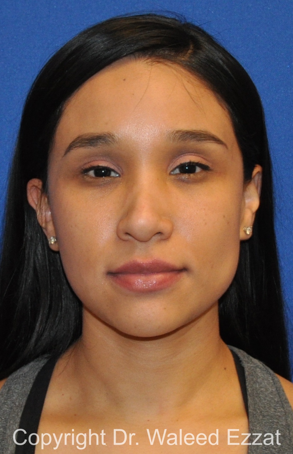 Hispanic/South American Rhinoplasty Patient Photo - Case 504 - before view-2