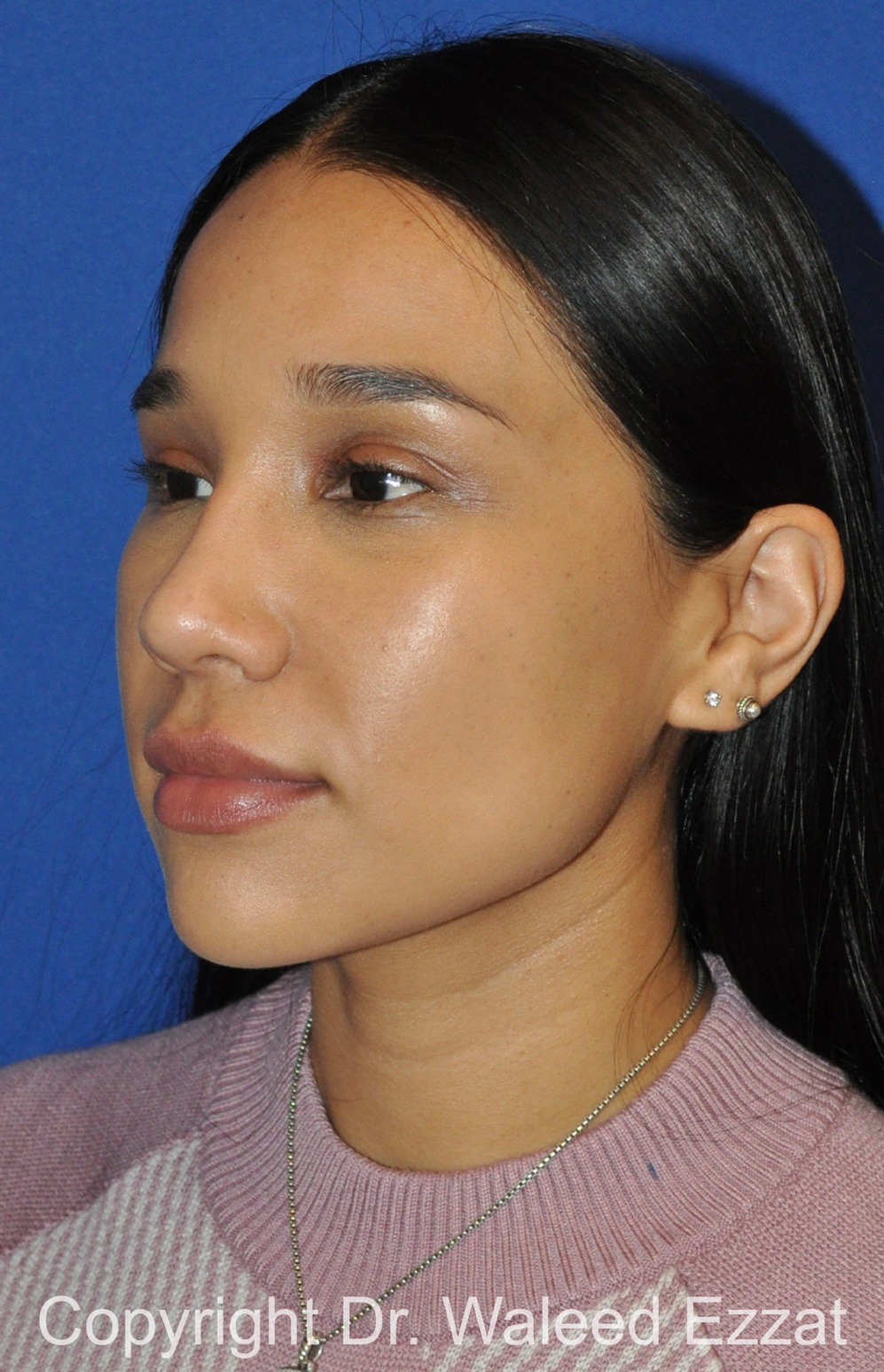 Hispanic/South American Rhinoplasty Patient Photo - Case 504 - after view-1
