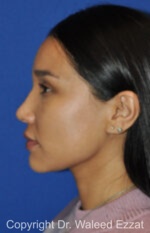 Hispanic/South American Rhinoplasty - Case 504 - After