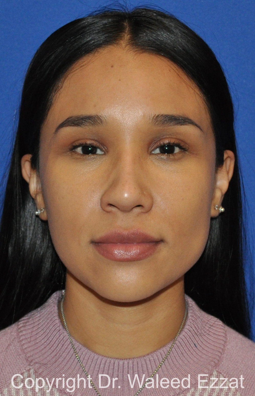 Hispanic/South American Rhinoplasty Patient Photo - Case 504 - after view-2
