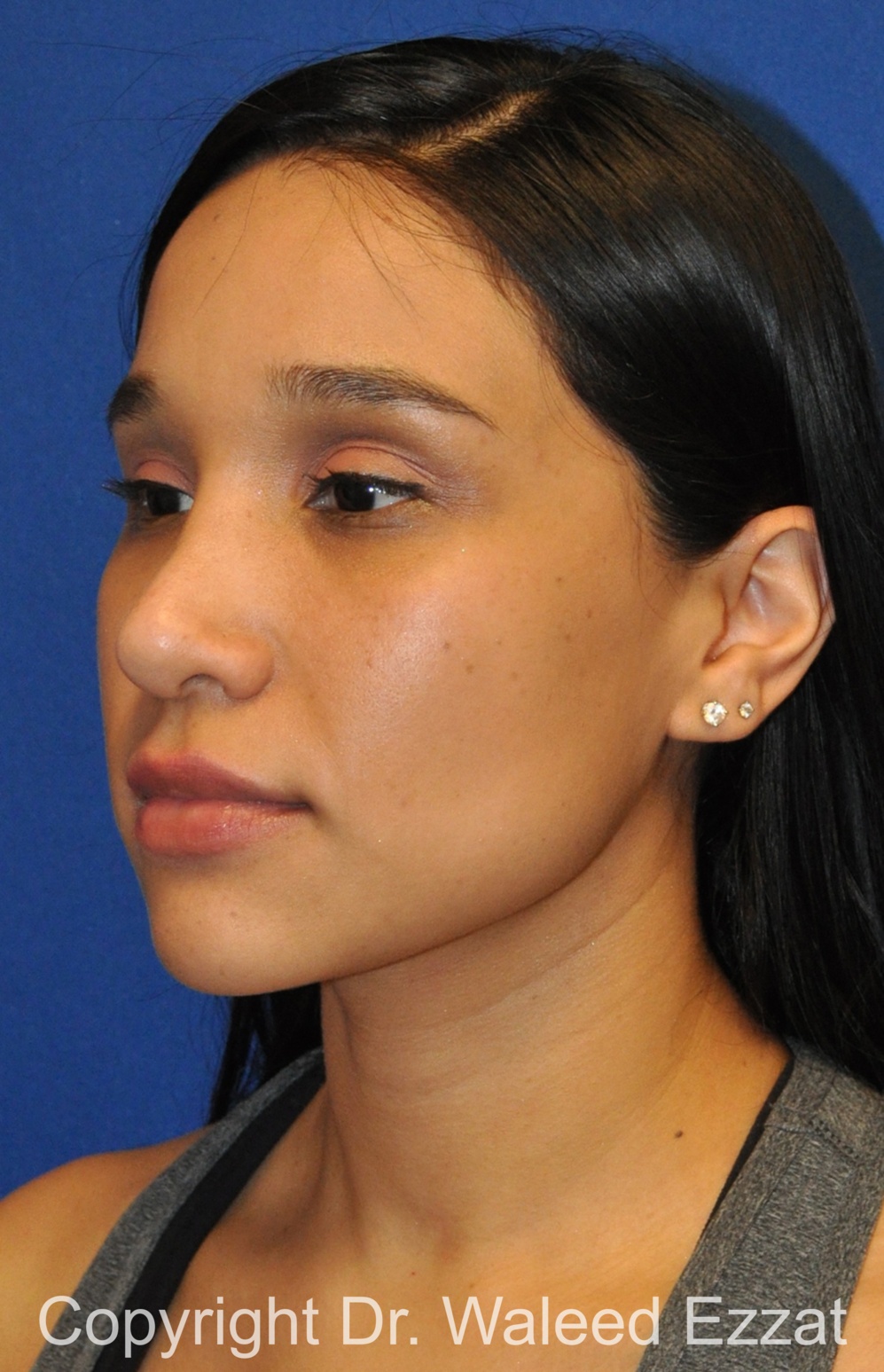 Hispanic/South American Rhinoplasty Patient Photo - Case 504 - before view-1