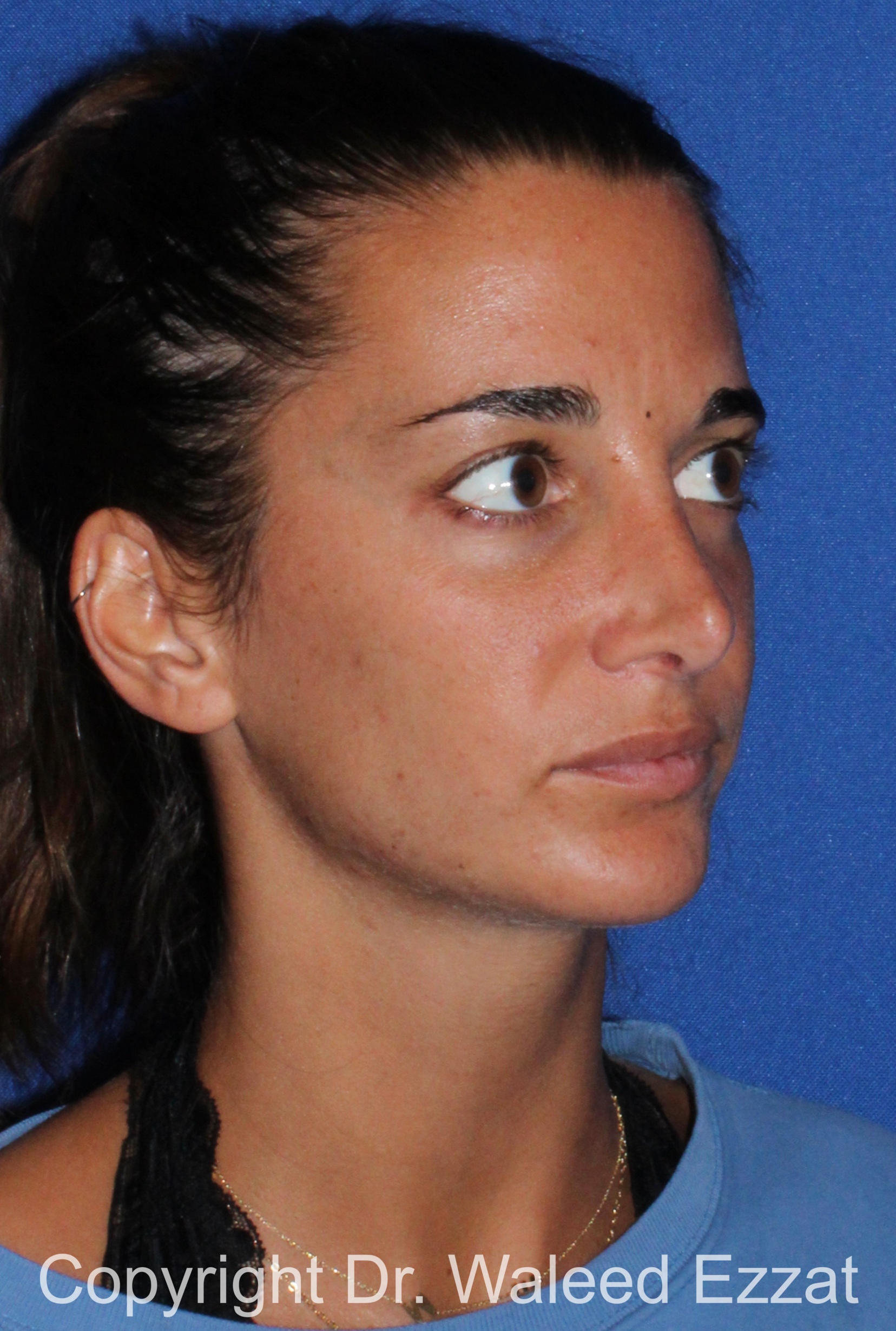 Revision Rhinoplasty Patient Photo - Case 505 - after view-1