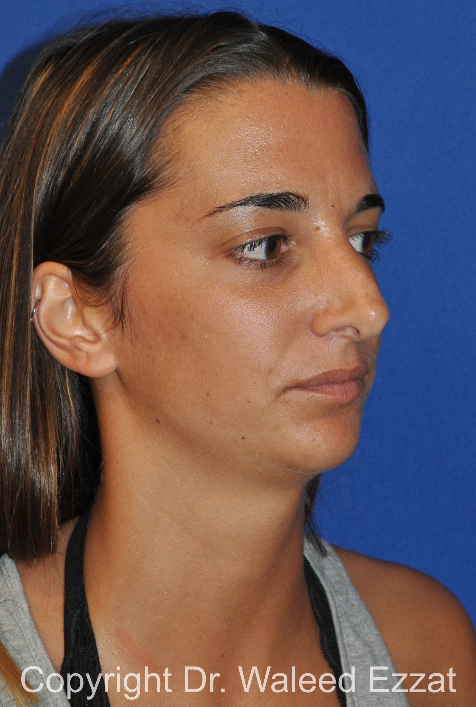 Revision Rhinoplasty Patient Photo - Case 505 - before view-1