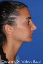 Revision Rhinoplasty - Case 505 - After