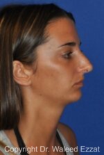 Revision Rhinoplasty - Case 505 - Before