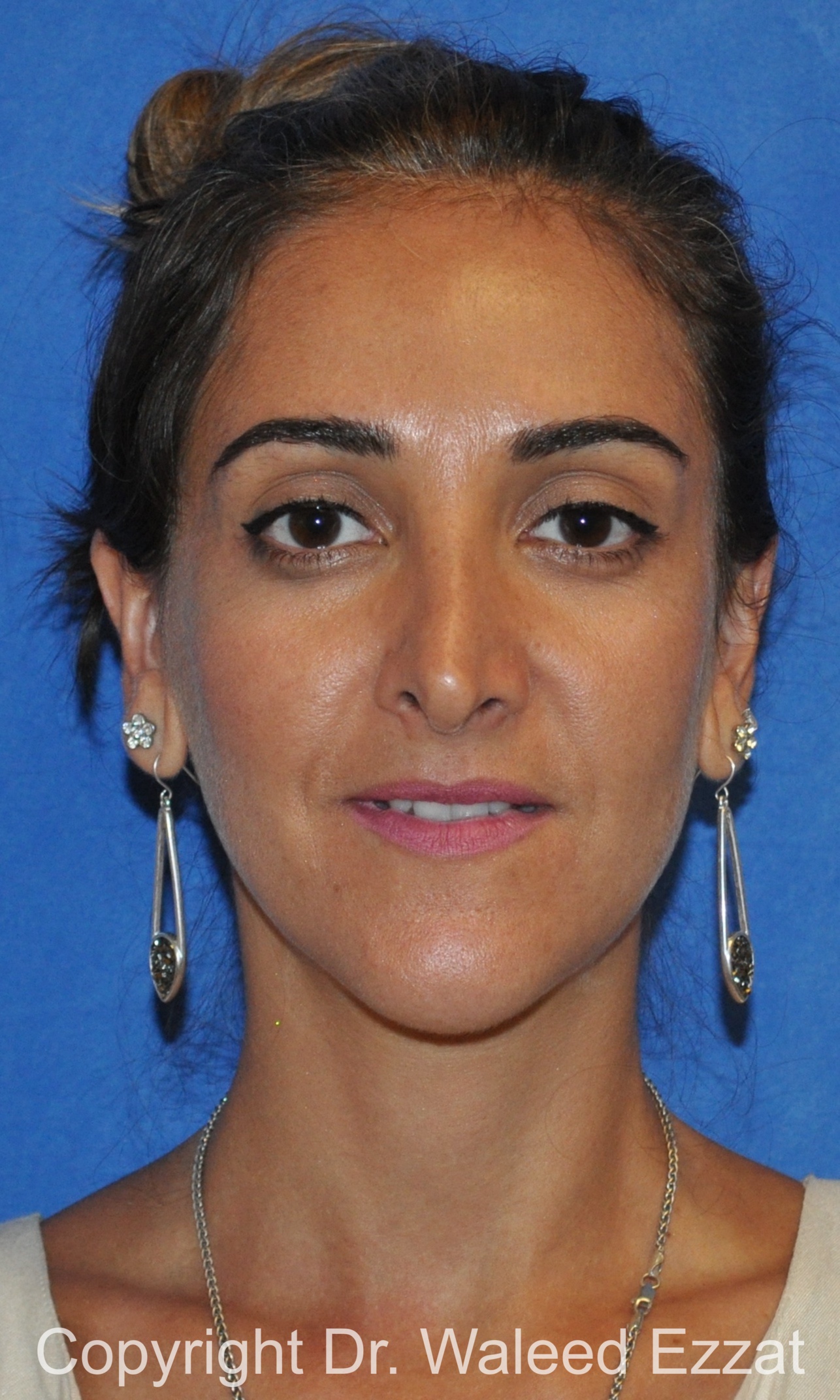 Revision Rhinoplasty Patient Photo - Case 506 - before view-2