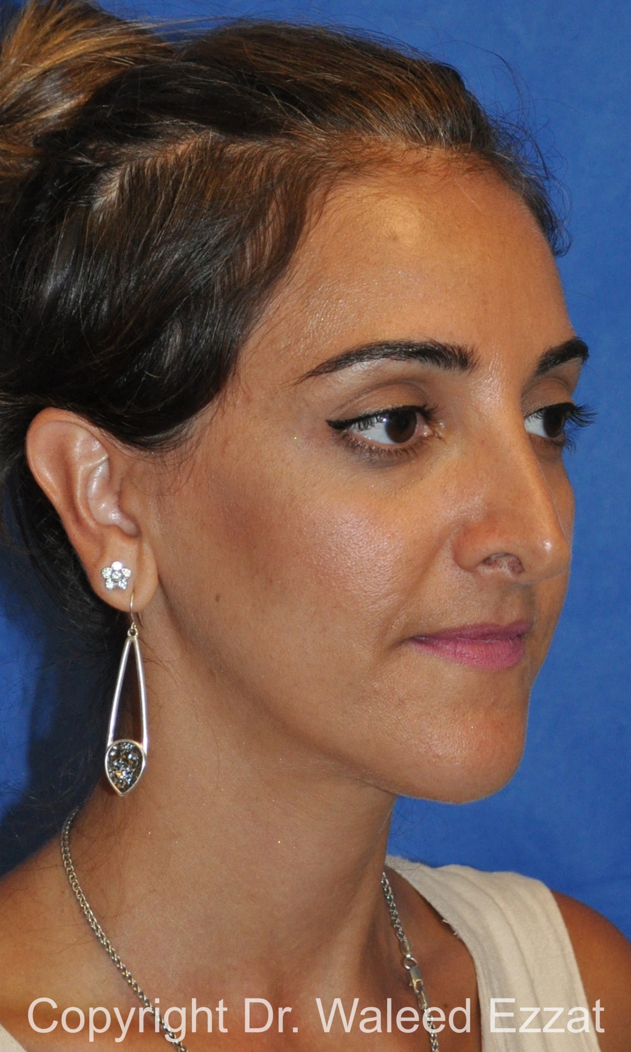 Revision Rhinoplasty Patient Photo - Case 506 - before view-1