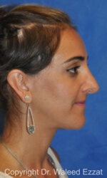 Revision Rhinoplasty - Case 506 - Before