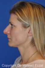 Revision Rhinoplasty - Case 507 - Before
