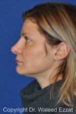 Revision Rhinoplasty - Case 507 - After
