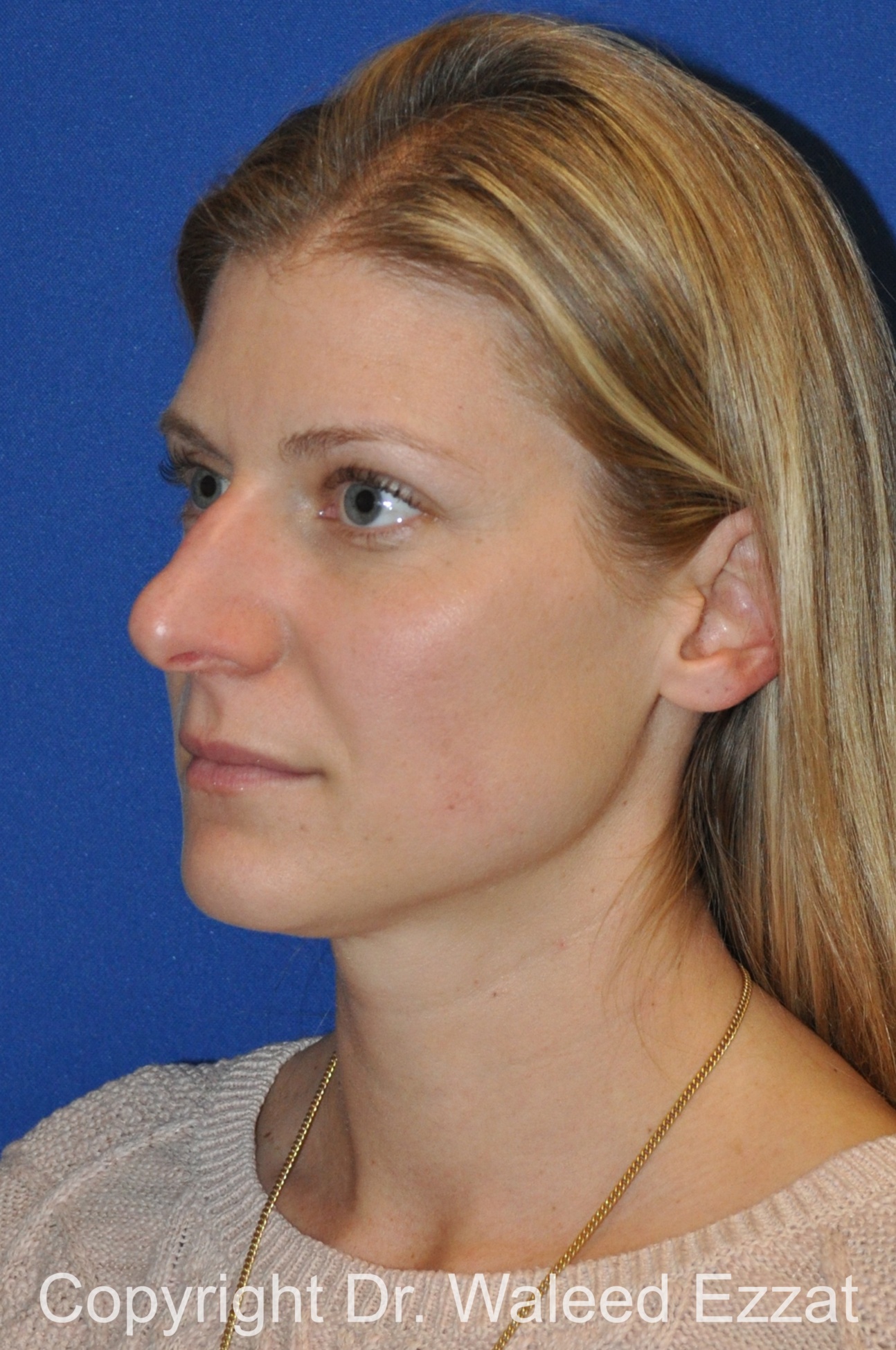 Revision Rhinoplasty Patient Photo - Case 507 - before view-1