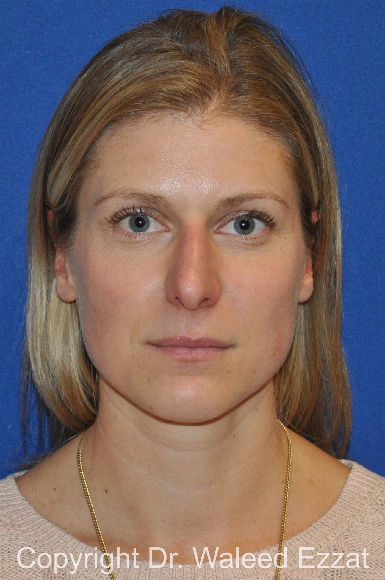 Revision Rhinoplasty Patient Photo - Case 507 - before view-2