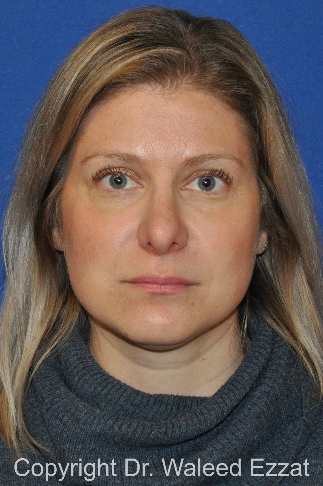 Revision Rhinoplasty Patient Photo - Case 507 - after view-2