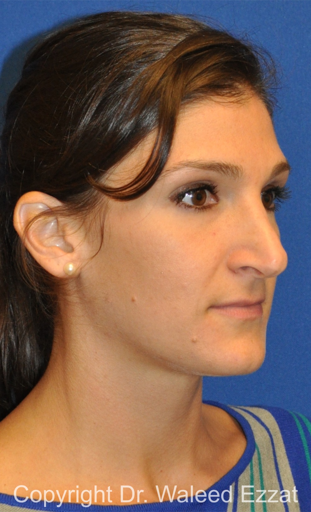Revision Rhinoplasty Patient Photo - Case 508 - before view-1
