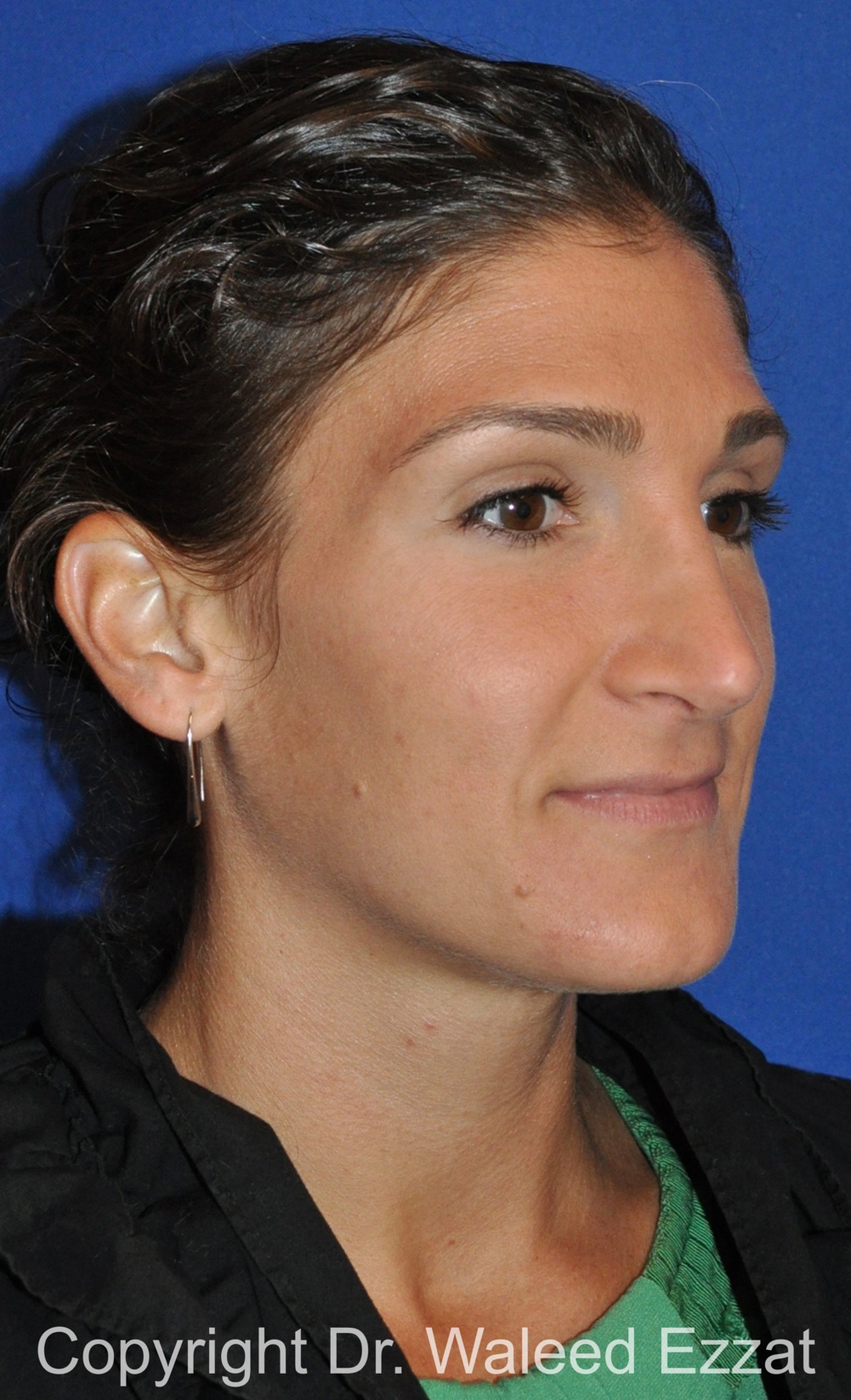 Revision Rhinoplasty Patient Photo - Case 508 - after view-1