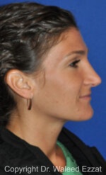 Revision Rhinoplasty - Case 508 - After