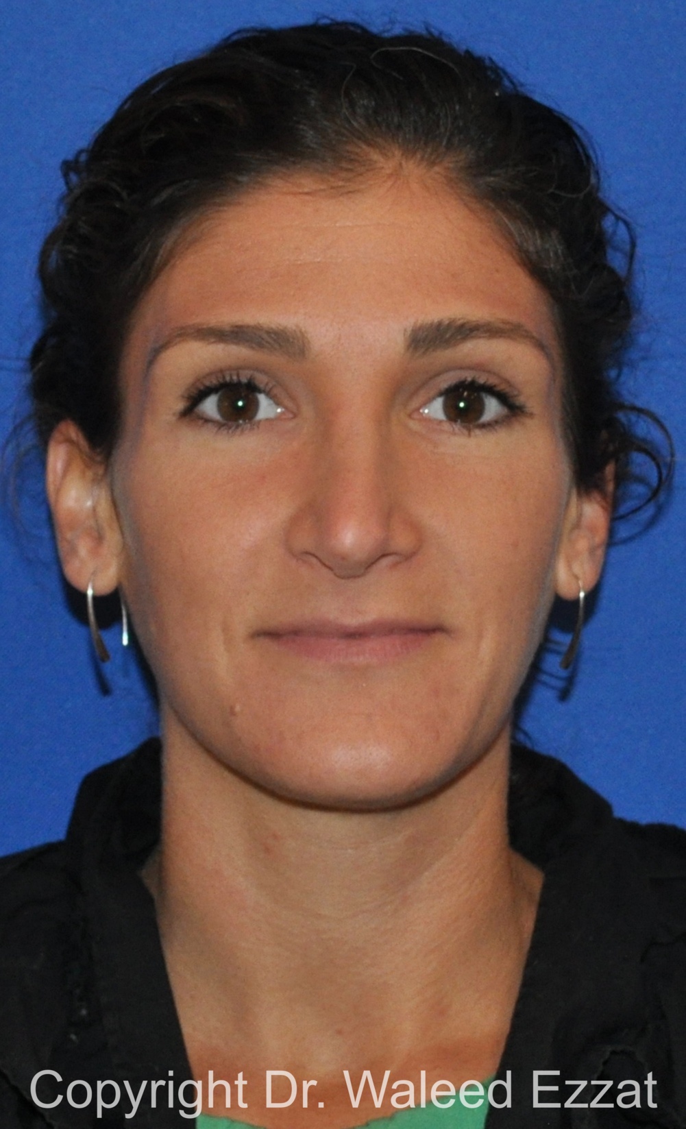 Revision Rhinoplasty Patient Photo - Case 508 - after view-2