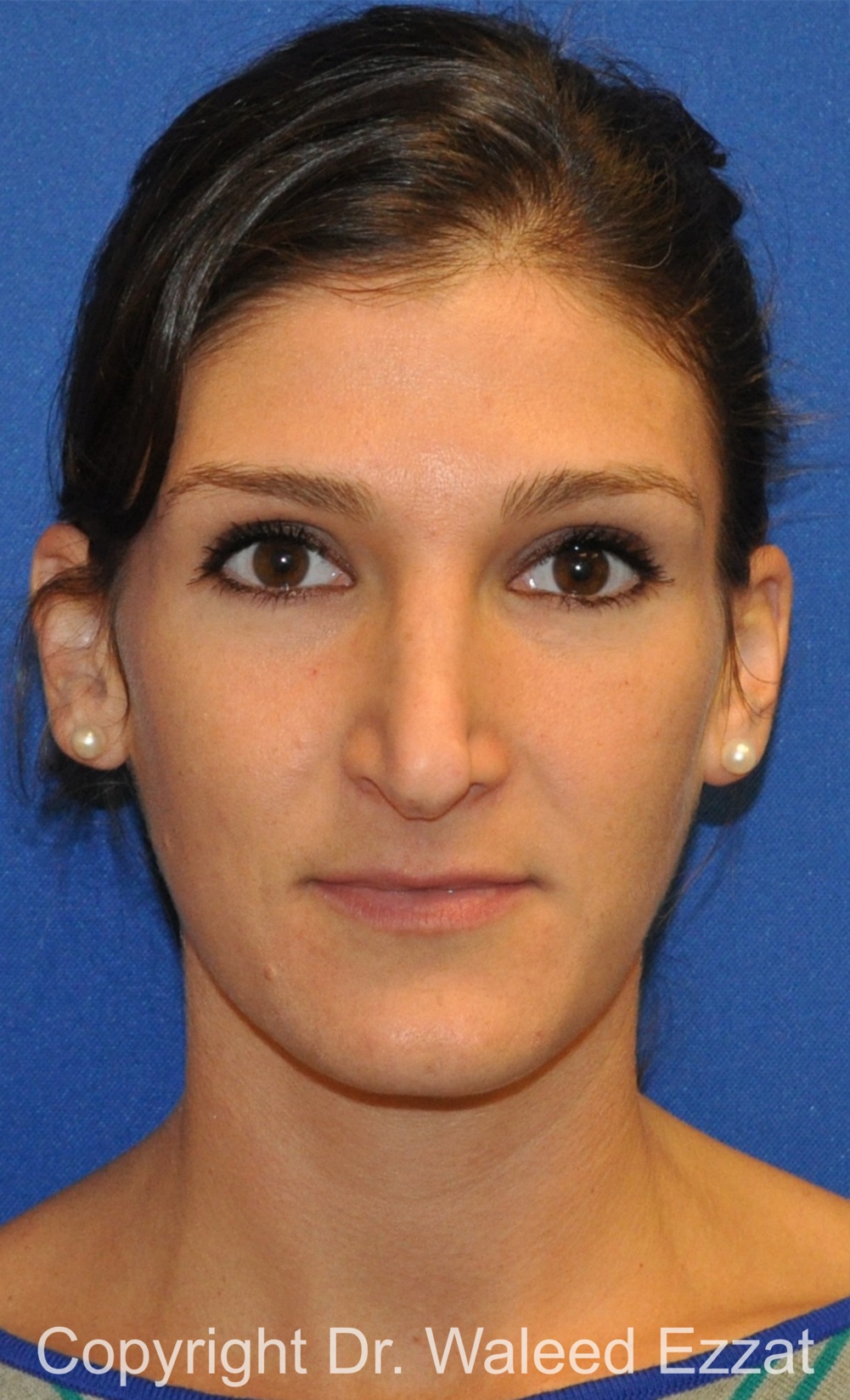 Revision Rhinoplasty Patient Photo - Case 508 - before view-2