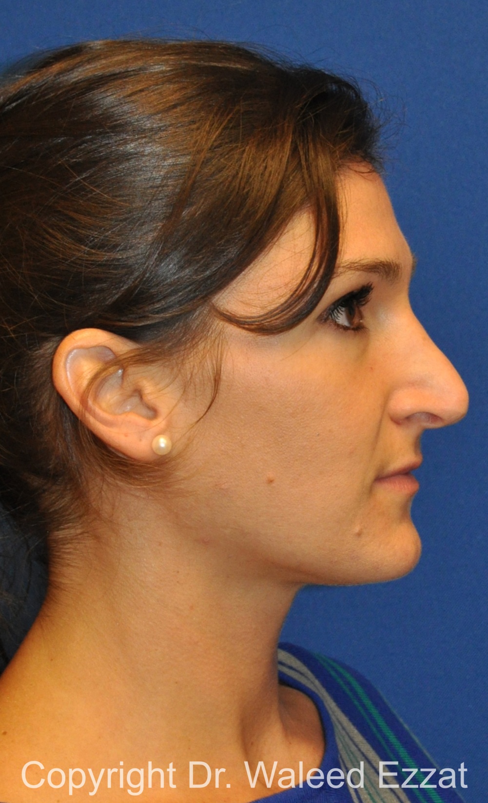Revision Rhinoplasty Patient Photo - Case 508 - before view-