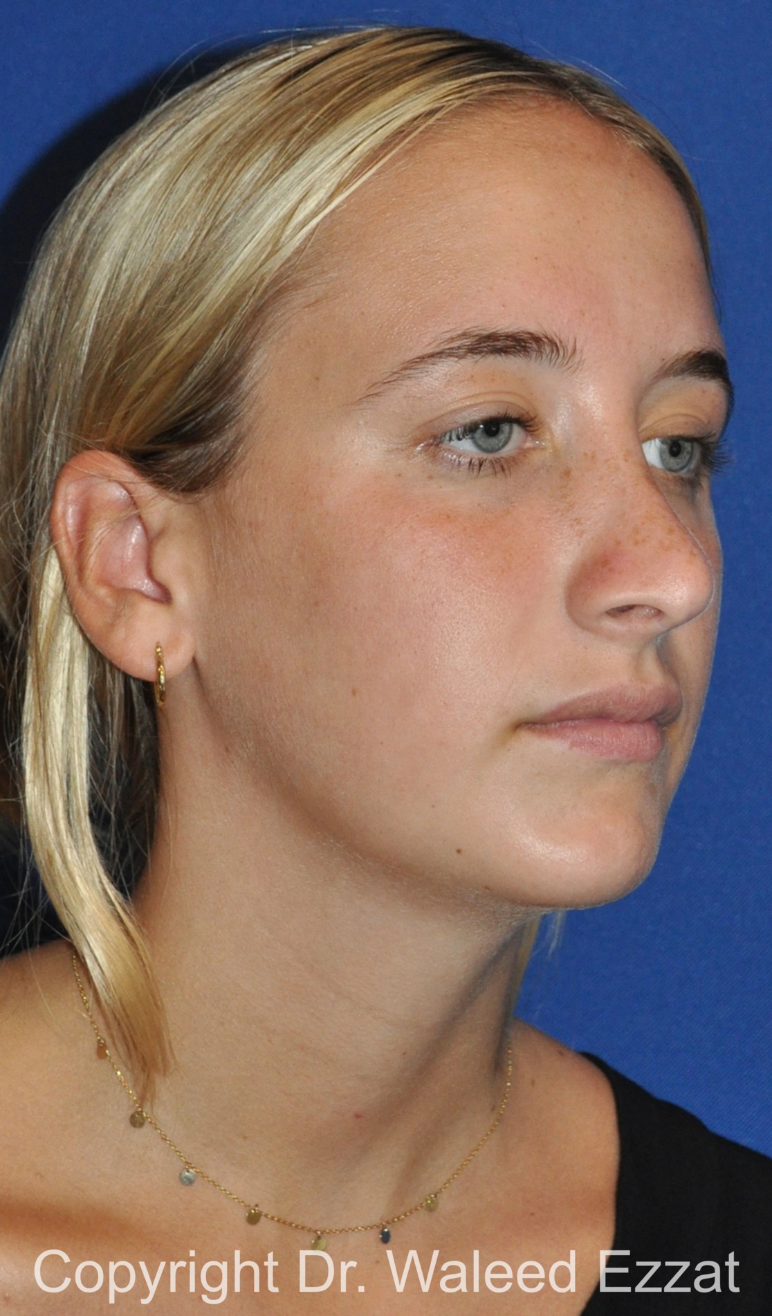 Revision Rhinoplasty Patient Photo - Case 509 - after view-1