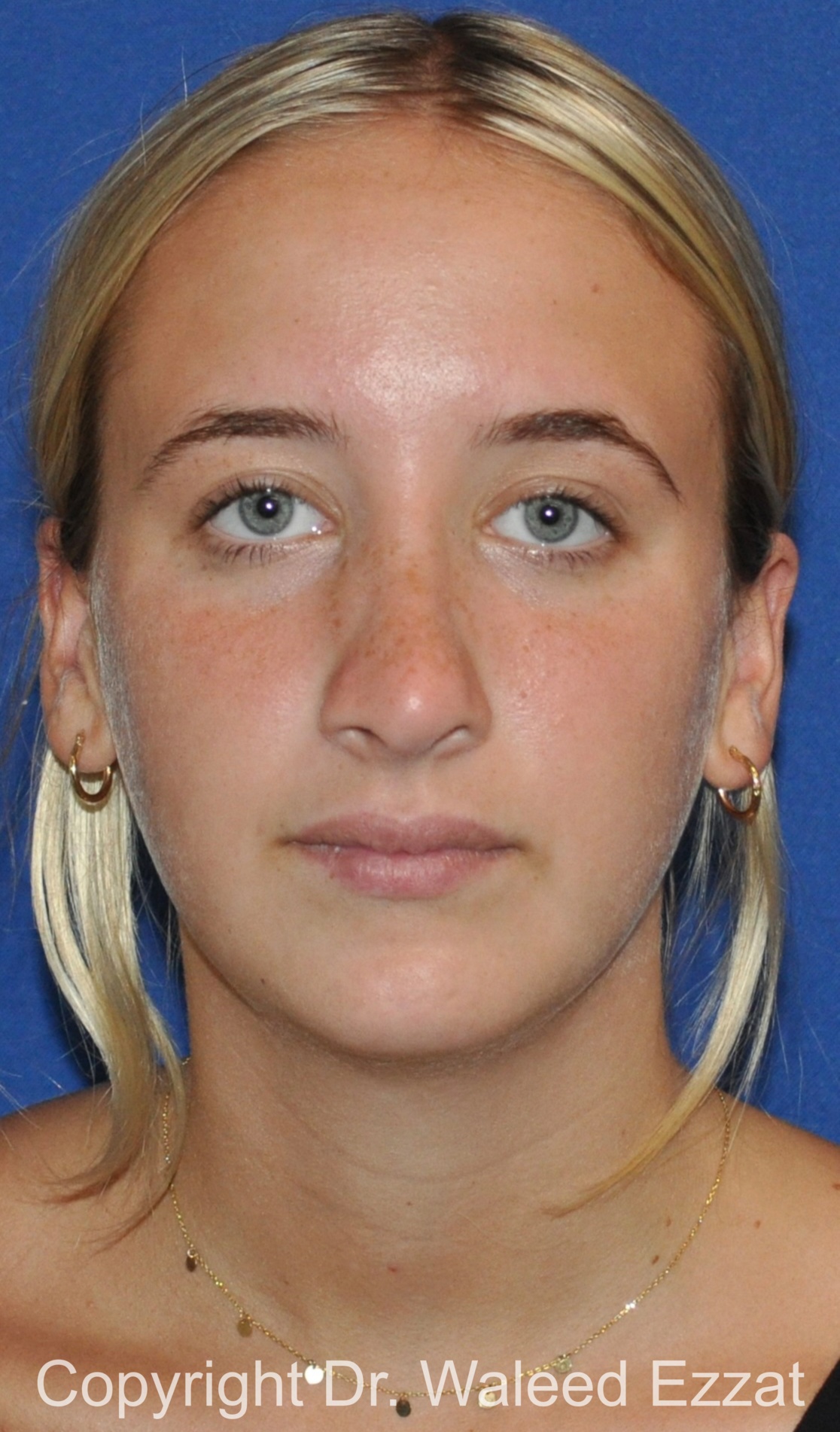 Revision Rhinoplasty Patient Photo - Case 509 - after view-2