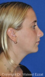 Revision Rhinoplasty - Case 509 - After