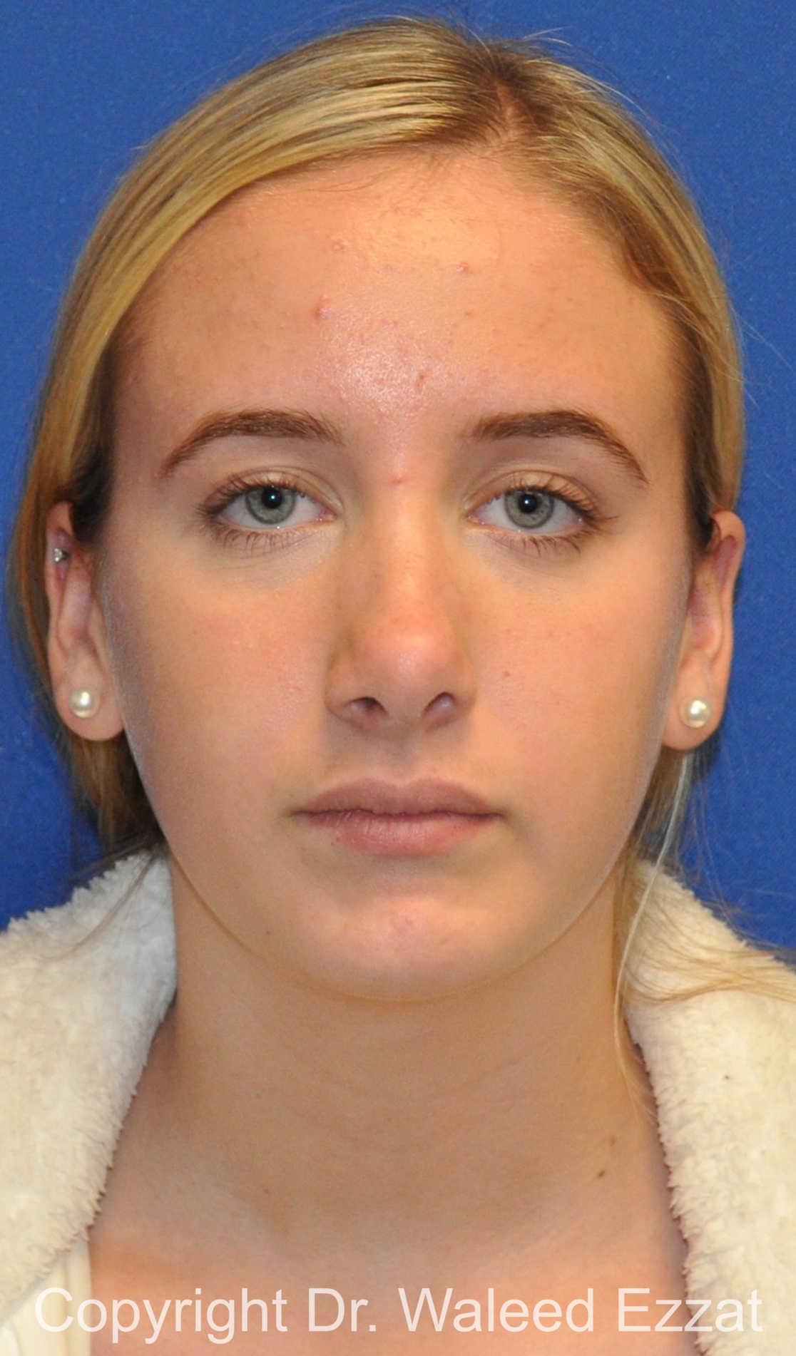 Revision Rhinoplasty Patient Photo - Case 509 - before view-2