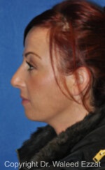 Revision Rhinoplasty - Case 510 - Before
