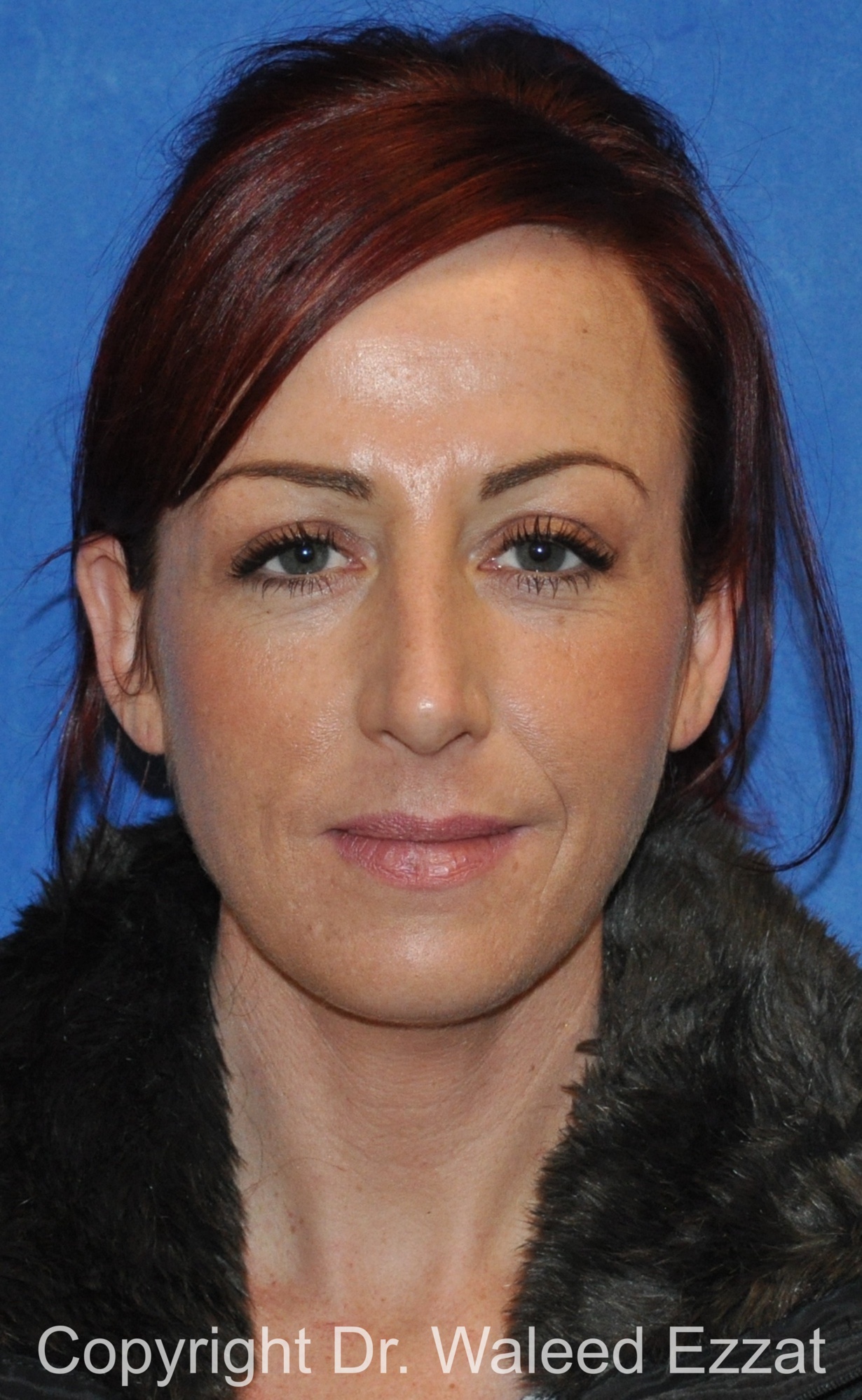 Revision Rhinoplasty Patient Photo - Case 510 - before view-2