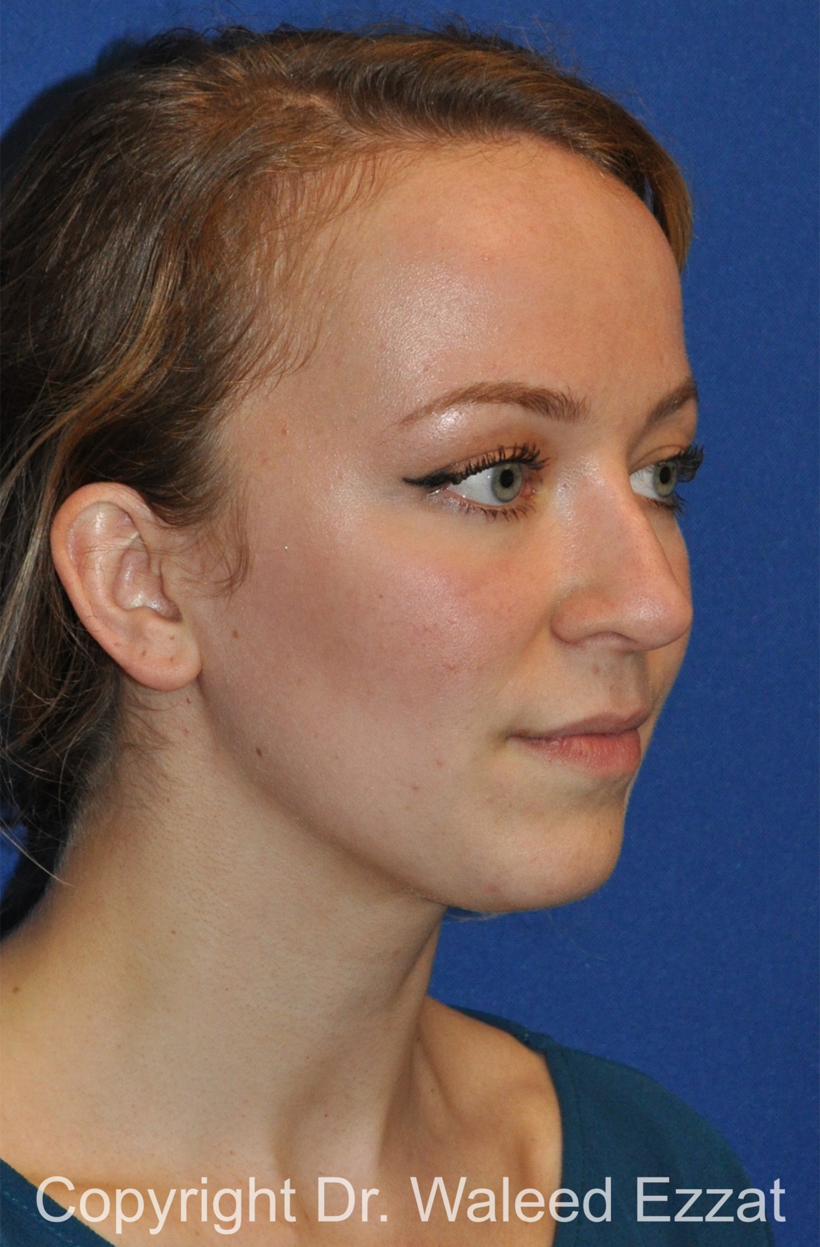 Revision Rhinoplasty Patient Photo - Case 511 - before view-1
