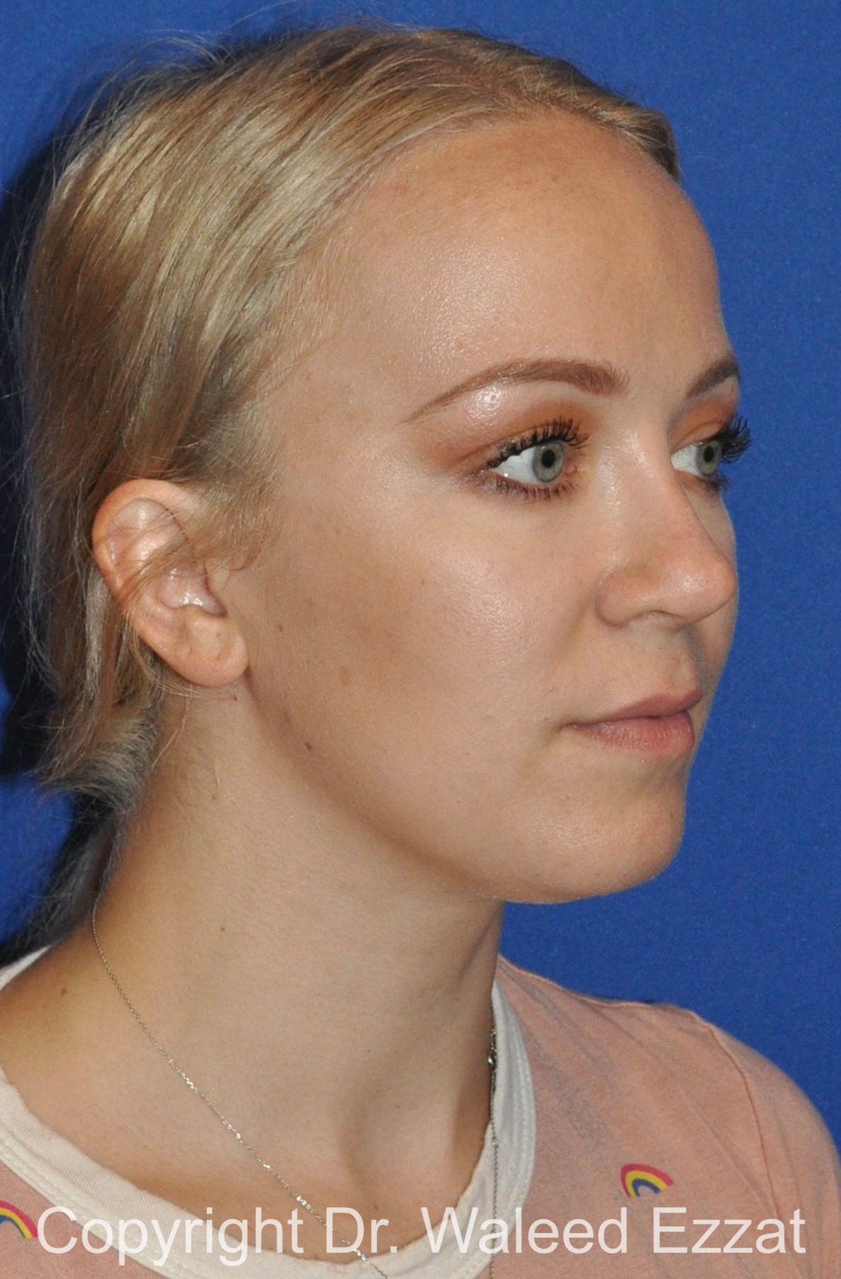 Revision Rhinoplasty Patient Photo - Case 511 - after view-1