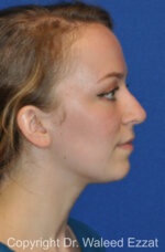 Revision Rhinoplasty - Case 511 - Before