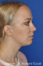 Revision Rhinoplasty - Case 511 - After