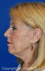 Revision Rhinoplasty - Case 512 - Before