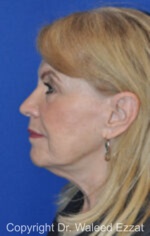 Revision Rhinoplasty - Case 512 - After