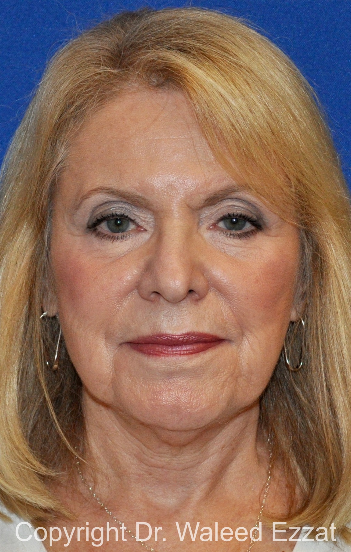 Revision Rhinoplasty Patient Photo - Case 512 - before view-2