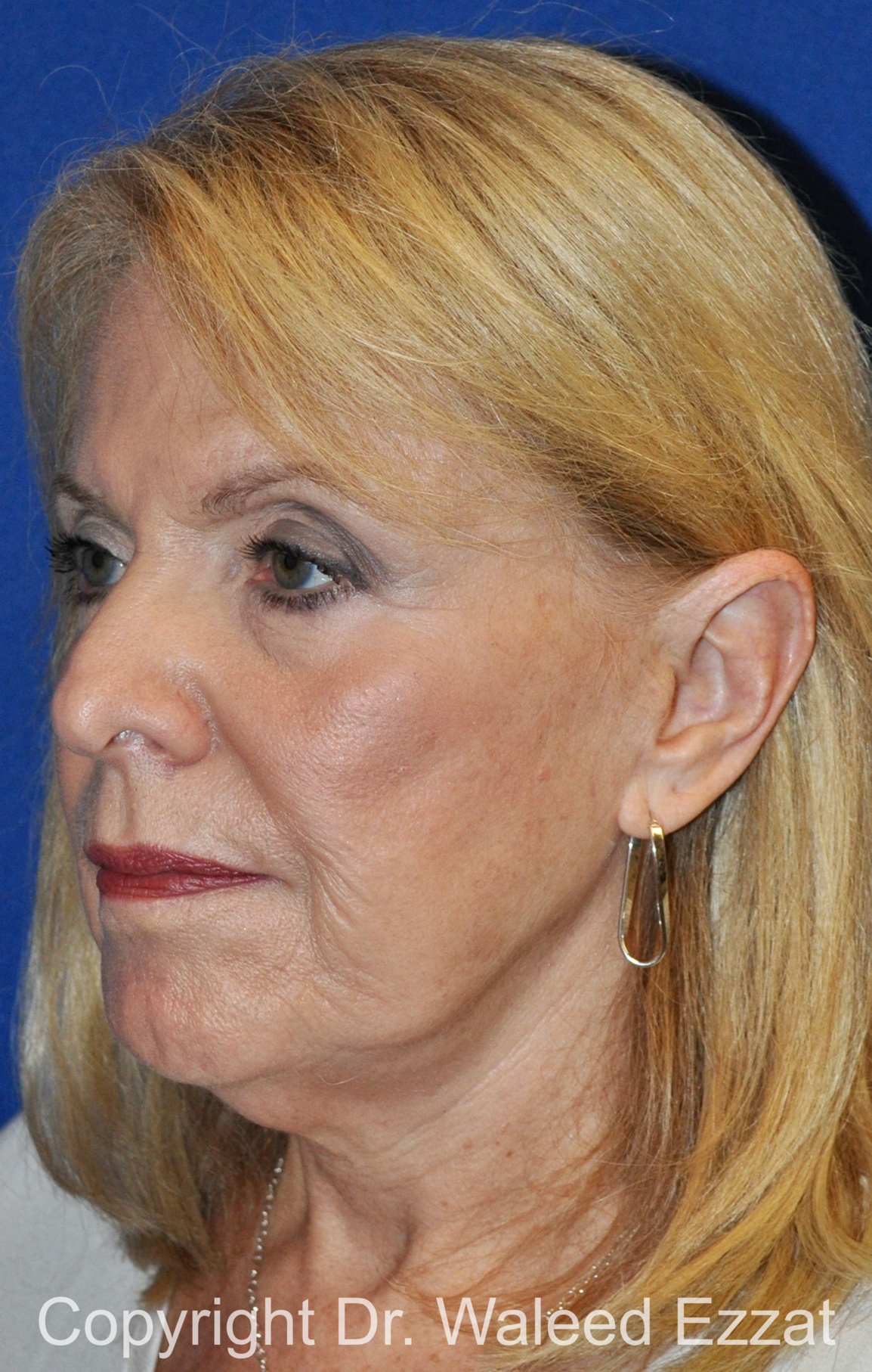 Revision Rhinoplasty Patient Photo - Case 512 - before view-1