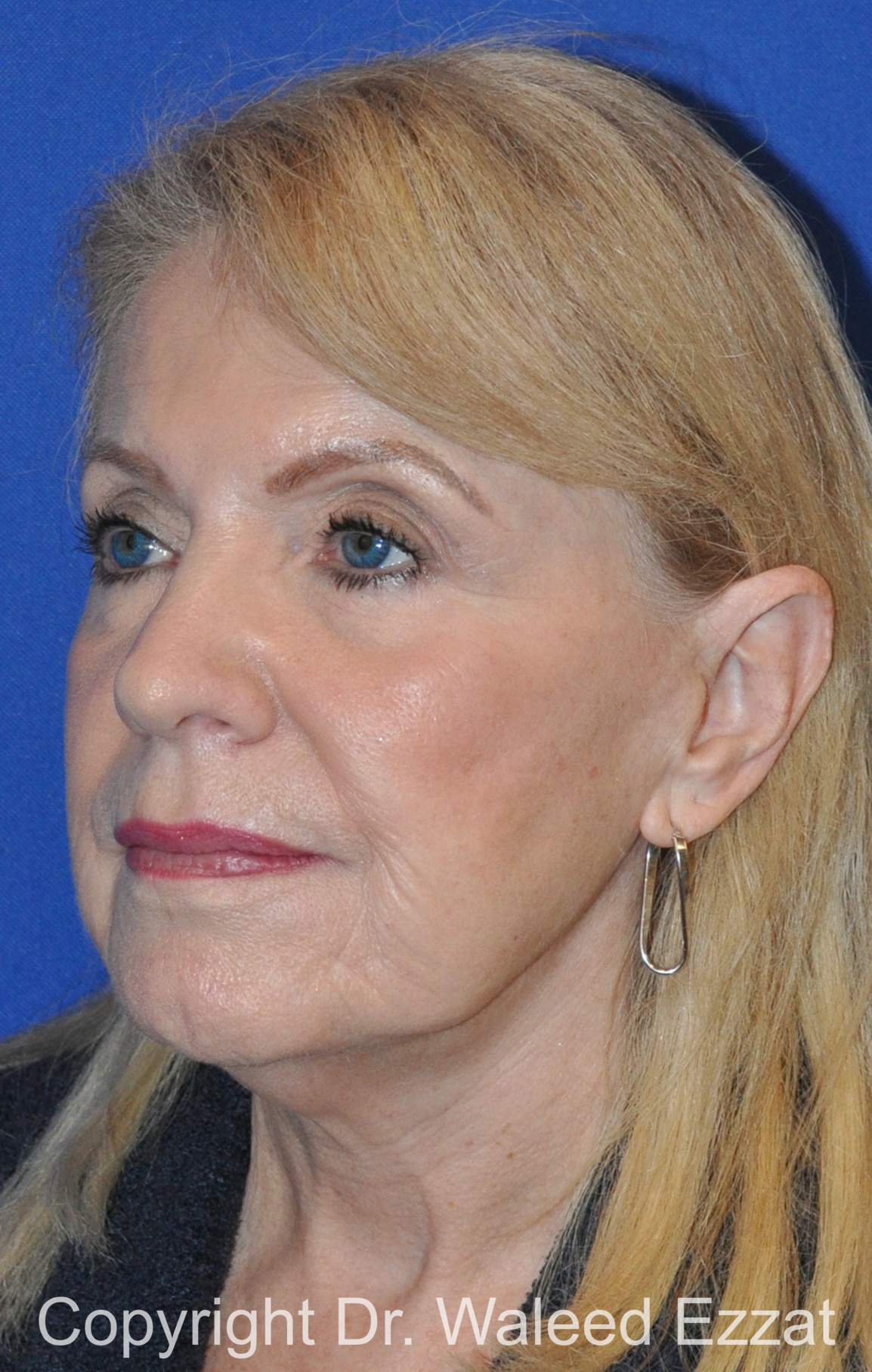 Revision Rhinoplasty Patient Photo - Case 512 - after view-1