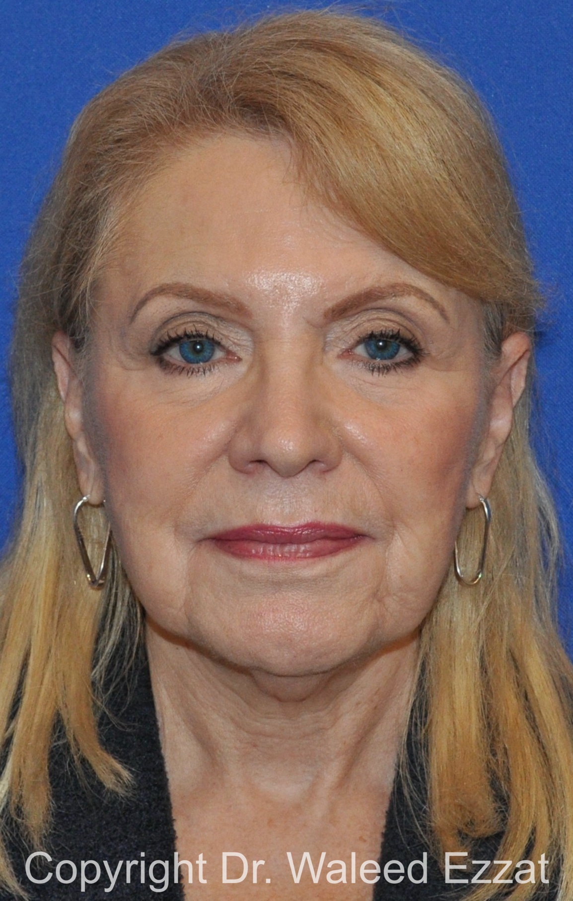 Revision Rhinoplasty Patient Photo - Case 512 - after view-2