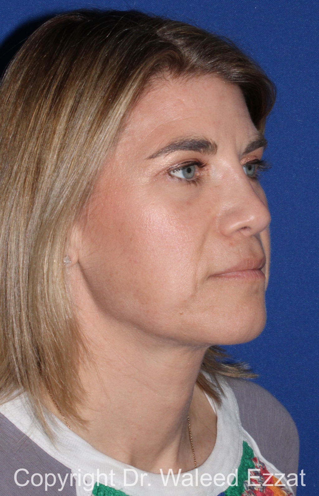 Revision Rhinoplasty Patient Photo - Case 513 - after view-1