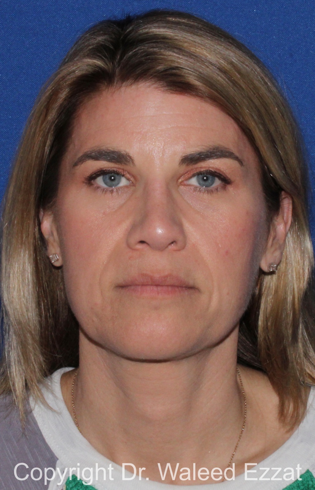 Revision Rhinoplasty Patient Photo - Case 513 - after view-2