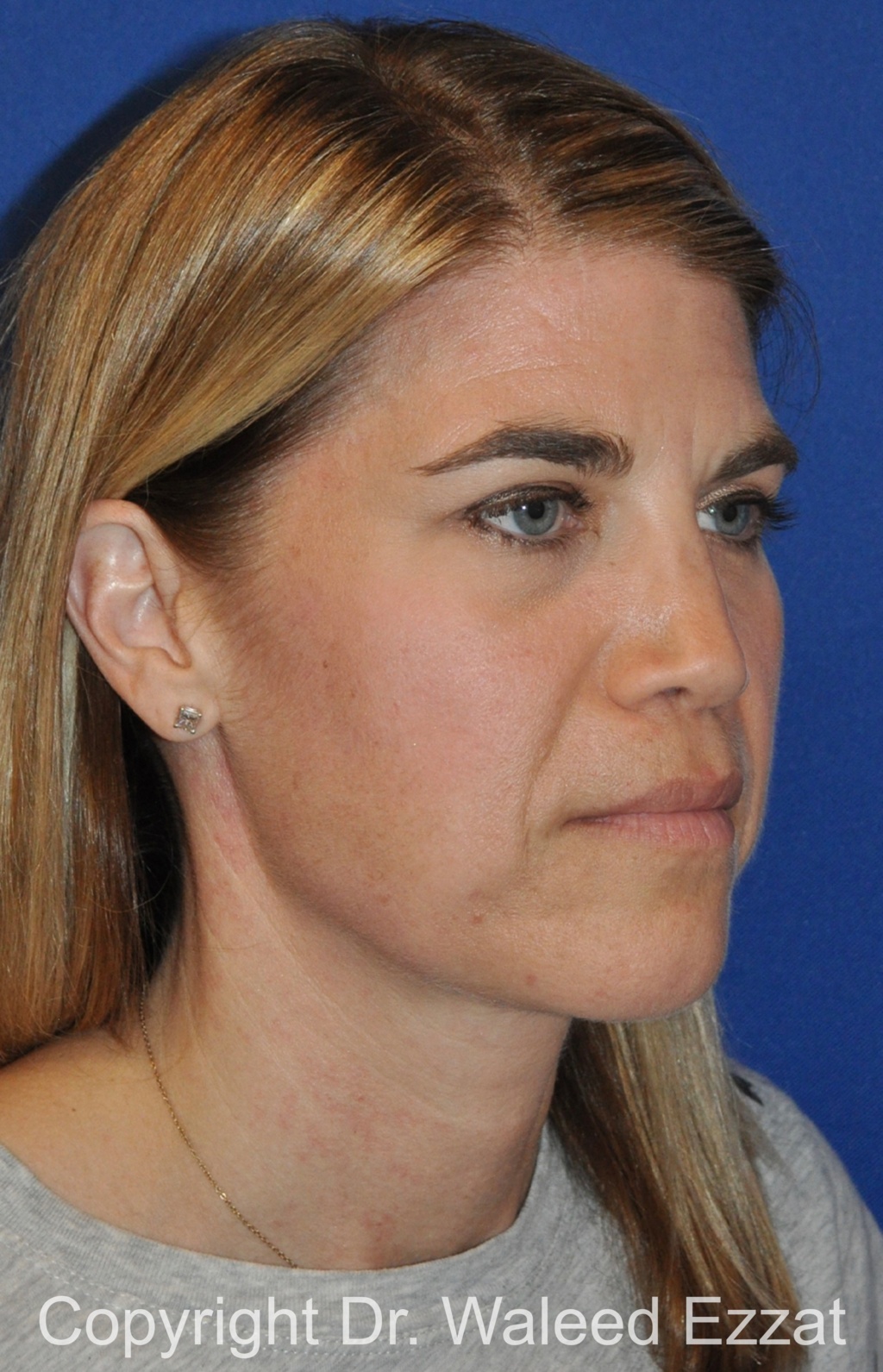 Revision Rhinoplasty Patient Photo - Case 513 - before view-1