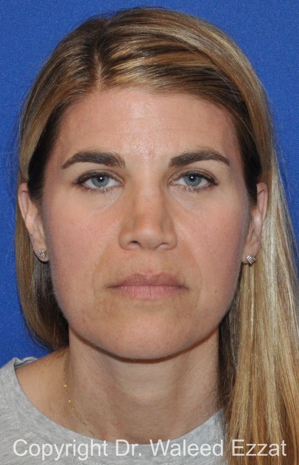 Revision Rhinoplasty Patient Photo - Case 513 - before view-2