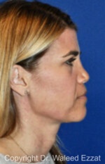 Revision Rhinoplasty - Case 513 - Before